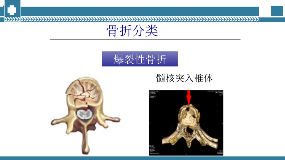 手术室腰椎手术配合PPT课件 腰椎压缩性骨折手术治疗PPT电子版8